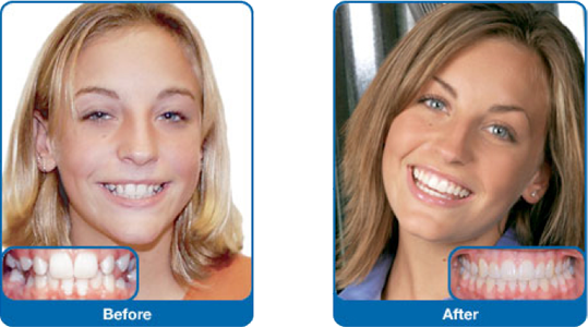 before and after braces adults