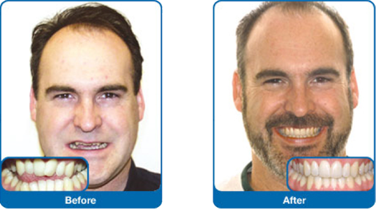 before and after braces adults